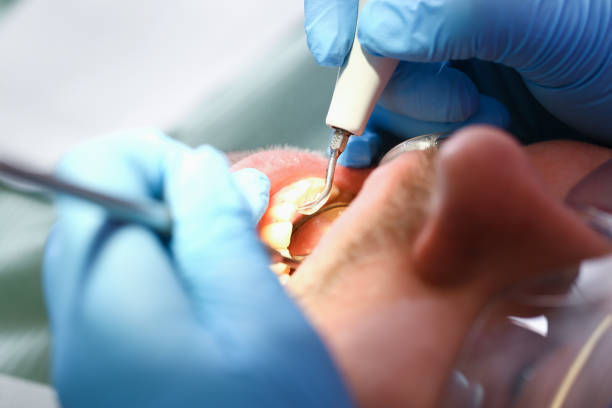 Best Emergency Wisdom Teeth Removal in Lake Leann, MI